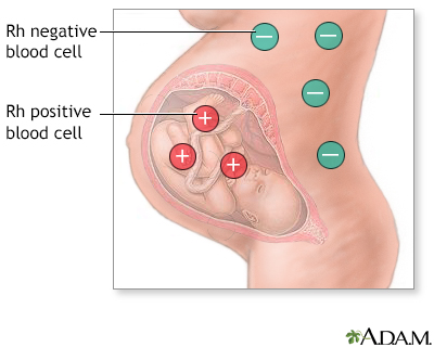 Rh Factor Incompatibility Chart